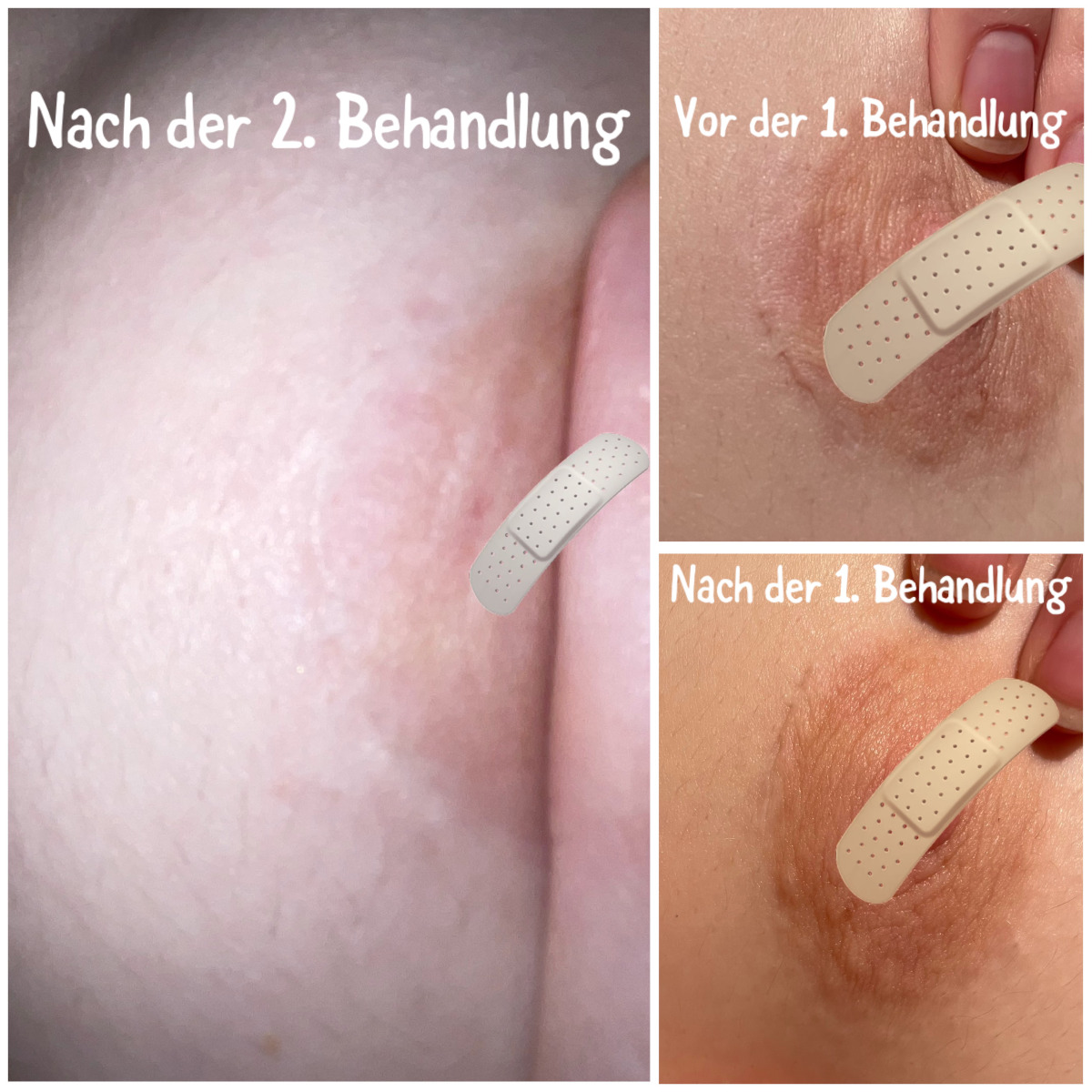 Narbenintegration an der Brust