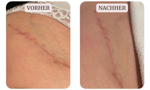 Narbenintegration nach Hüftgelenksersatz