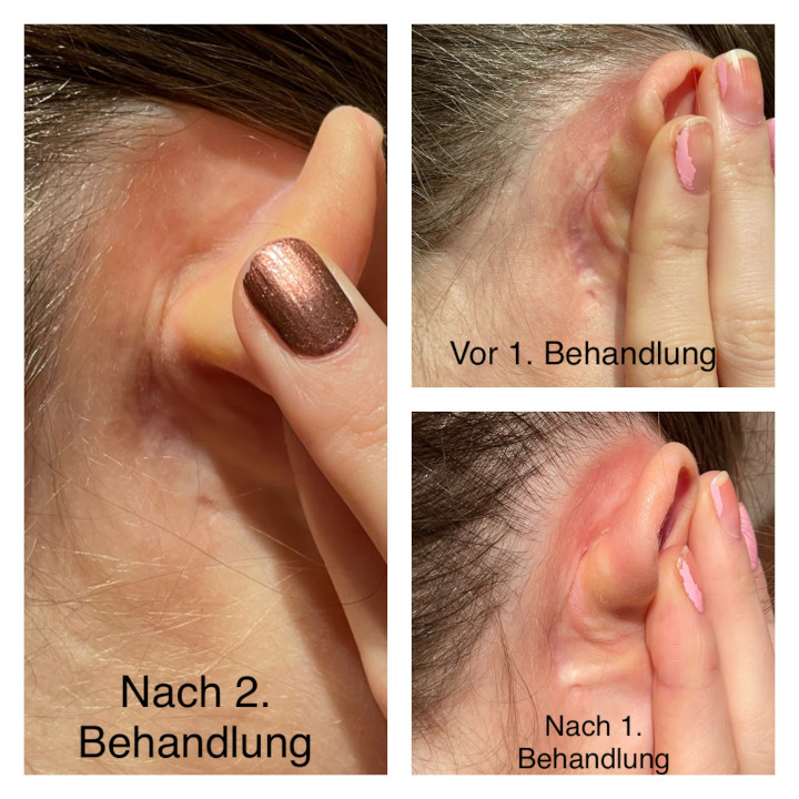 Narbenintegration am Ohr